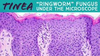 quotRingwormquot under the microscope tinea dermatophytosis fungal folliculitis Majocchi pathology [upl. by Hadden]