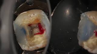 Complete endodontic treatment of a lower first molar step by step [upl. by Elva]