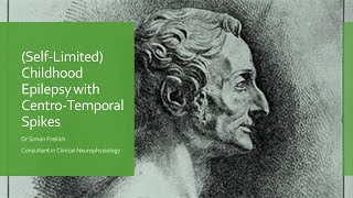 Childhood Epilepsy with Centro Temporal Spikes Originally Rolandic Epilepsy [upl. by Liggitt]