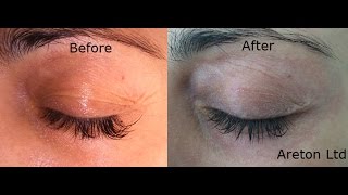 Plasma Upper eyelid tightening [upl. by Lletnahc]