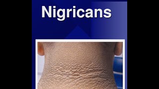 Acanthosis Nigricans [upl. by Esertap]