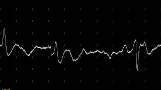 EMG teaching video 4 Fasciculation potentials in the tongue [upl. by Clarisa186]