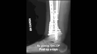 SECUELA DE FRACTURA DE PILON TIBIAL TRATADA MEDIANTE OSTEOTOMIA DE TIBIA DISTALmov [upl. by Meit323]