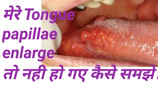 Tongue papillae enlarge हो गए यह कैसे समझे Tongue papillae location folliate circumvallet papillae [upl. by Sofer821]