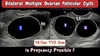 TVS Ultrasound  Bilateral multiple Ovarian Follicular Cysts [upl. by Dnalloh618]