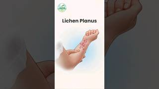 Lichen Planus Causes and Symptoms shorts [upl. by Khudari]