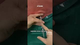 Spinal anesthesia Procedure spinalanesthesia anesthesiologist funny [upl. by Phillada]