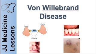 Von Willebrand Disease  Pathophysiology Types Symptoms and Treatment [upl. by Akcimehs]