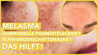 MELASMA Behandlung – So wirst Du die Pigmentflecken im Gesicht endlich los [upl. by Eimar]