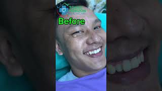 Sebaceous cyst  removal  dr bijay  tokha horizon [upl. by Ylrebnik442]