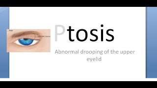 Ophthalmology 388 a Ptosis Congenital Types Classification Definition What is Define Classify [upl. by Netsua]