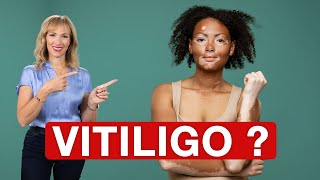 WHAT Causes VITILIGO  Dr Janine [upl. by Notgnillew]