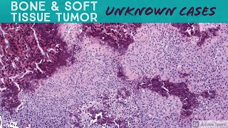 Soft Tissue amp Bone Tumor Pathology Unknown Cases Yale see video description for digital slides [upl. by Marcela]