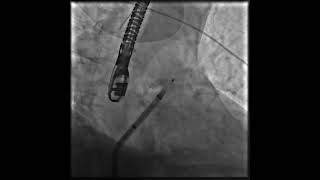 “Ground Zero”  LAA Occluder Implant [upl. by Newkirk]