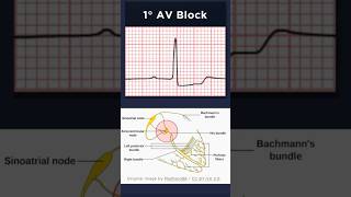 First Degree Atrioventricular Block ECG [upl. by Elie]