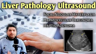 Focal Nodular Hyperplasia Hepatocellular Carcinoma amp Hepatic Adenoma  Liver Ultrasound Explained [upl. by Webster]