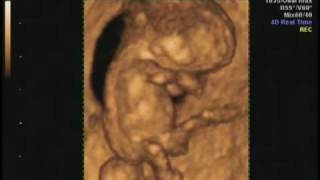 9 weeks 2 days 4D Ultrasound [upl. by Aivata]