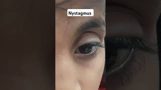 NYSTAGMUS [upl. by Yleen]