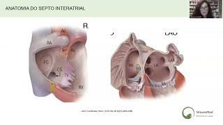 Aula completa Punção transseptal Wavesmed [upl. by Rebane]