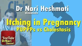 Itching in Pregnancy PUPPPs vs Cholestasis of Pregnancy Discussed by Dr Nari Heshmati [upl. by Lynnelle]