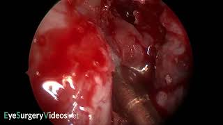 Endo DCR agger nasi and uncinate anatomy [upl. by Wolbrom]