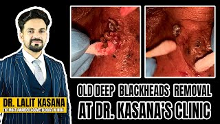 OLD DEEP BLACKHEADS REMOVAL AT DRKASANAS CLINIC [upl. by Forlini]