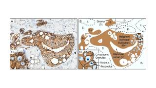 XMRV a New Human Retrovirus Lecture 25 [upl. by Buskirk]