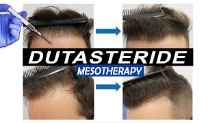 Mesotherapy with Dutasteride Injections Pros and Cons and what Results to expect [upl. by Cadell]