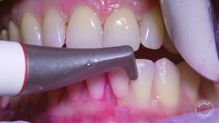 How teeth should be cleaned at the Dentist  Hygienist [upl. by Elleret]