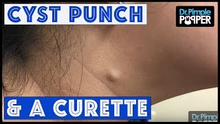 Cyst Punch amp Curette [upl. by Eylatan]