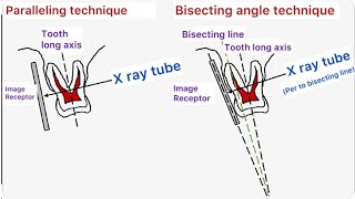 Dental Radiography Parallel angle vs Bisecting angle technique Basics  Part 1 [upl. by Marchal]