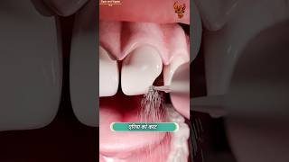 How teeth are fixed 😳 दांत कैसे ठीक होते हैं  shorts [upl. by Kylie]