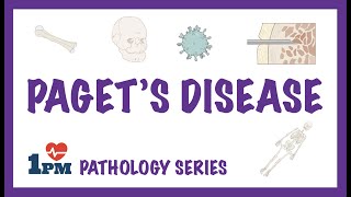 Pagets Disease  Pathology Causes Symptoms Diagnosis Treatment [upl. by Salman]