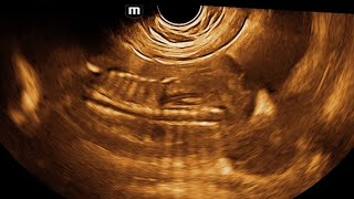 Bilateral renal agenesis with ccam fetal ultrasound [upl. by Yeldud]