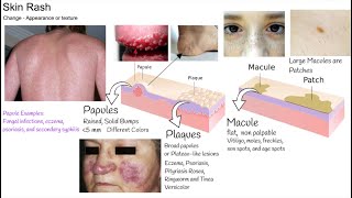 Understanding Rash in 3 minutes Skin Rash types and causes [upl. by Nnyled]