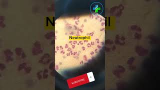 High neutrophil count in peripheral smear  neutrophils  CBC  Causes of Neutrophilia  hematology [upl. by Rico]