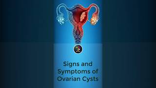 Signs and Symptoms of Ovarian Cysts [upl. by Zima]