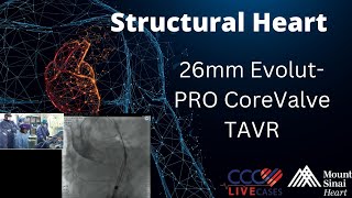 26mm EvolutPRO CoreValve TAVR  March 13 2018 [upl. by Aryk319]