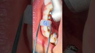 Indirect bonding of the lingual selfligating braces [upl. by Huggins584]