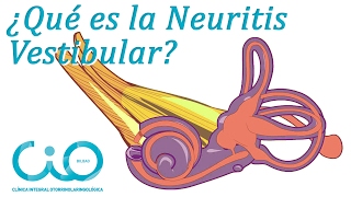 ¿Neuritis vestibular ¿Vértigo  Otorrinos CIO Bilbao [upl. by Peer478]