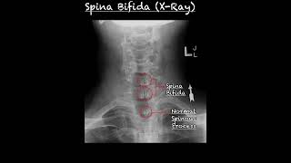 Spina Bifida X ray vs Normal  Spina Bifida Anatomy Animation Radiology  Spina bifida shorts [upl. by Ardna705]