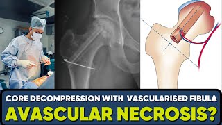 Role of Core decompression amp Vascularised Fibular Grafting in AVN drpankajwalecha [upl. by Rhines]