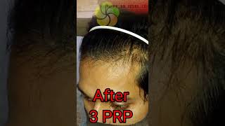 PRP Hair Treatment  PRP Results Before And After  PRP Results [upl. by Inahs]