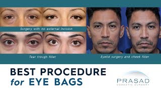 Best Procedures for Treating Puffy Under Eye Bags and Adjacent Hollowness [upl. by Nitaf]