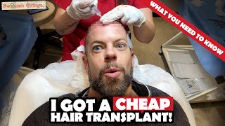 Had a Cheap Hair Transplant in Turkey – This Happened  SURGERY amp FIRST 6 WEEKS [upl. by Judon]