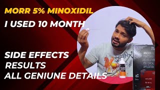 Minoxidil Morr f 5 Results  Morr F 5  Minoxidil and finasteride side effects [upl. by Norina]