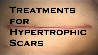 Treatments for Hypertrophic Scars [upl. by Romina]