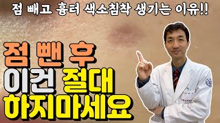 점빼고 흉터 색소침착 남지 않는✔️ 점제거 후관리 방법 [upl. by Sdlonyer]