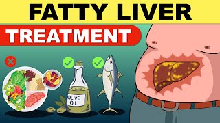 Fatty Liver Treatment  Fatty Liver Diet  Liver Detox  Fatty Liver  Fatty Liver Symptoms [upl. by Euqitsym]