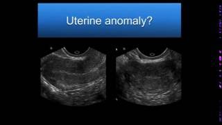 AIUM Webinar Problem Solving with 3D Sonography of the Uterus and Adnexa [upl. by Llewen]